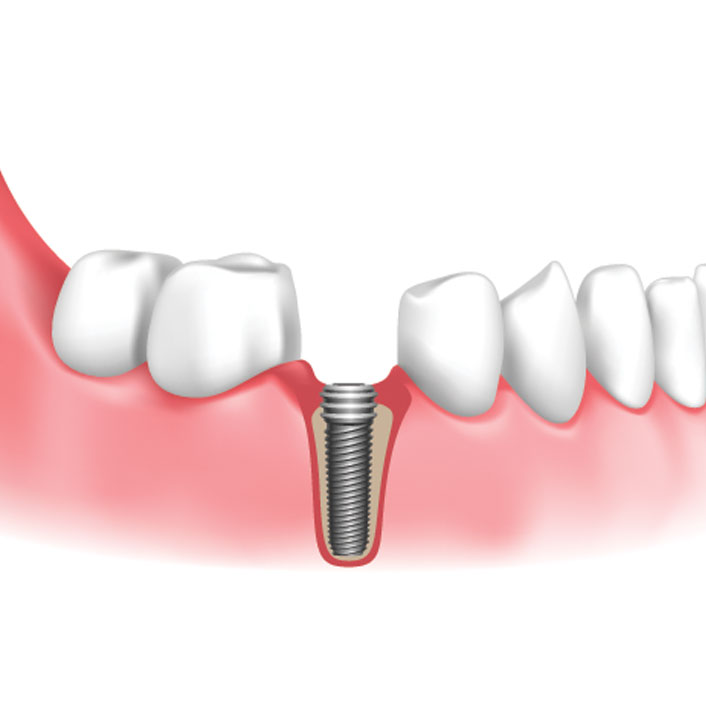 Dental Implants - Dental Services
