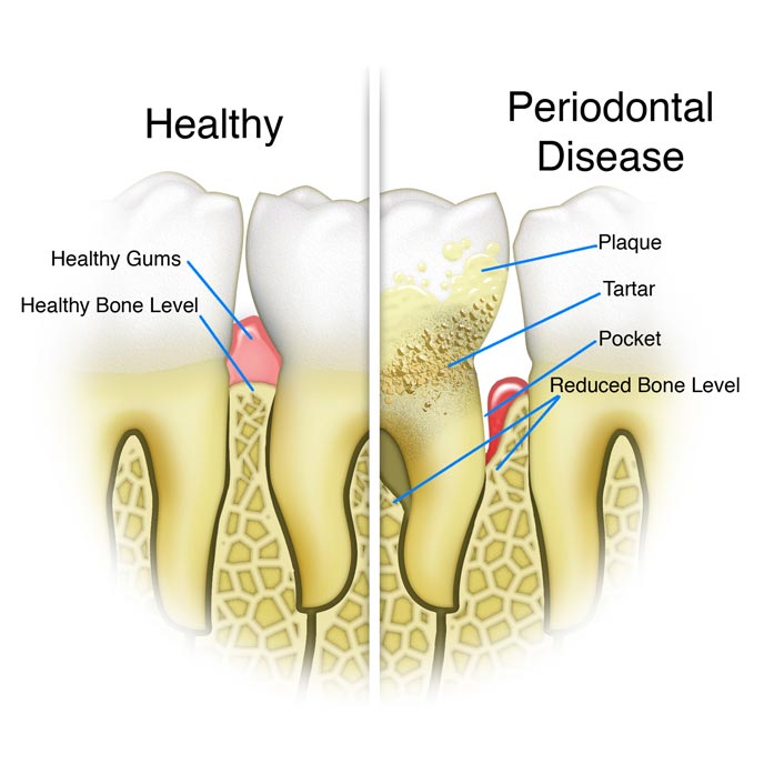 Periodontal Therapy